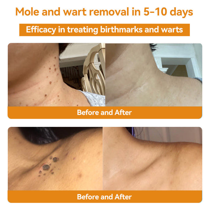 TagAway | Effective removal of warts and skin growths