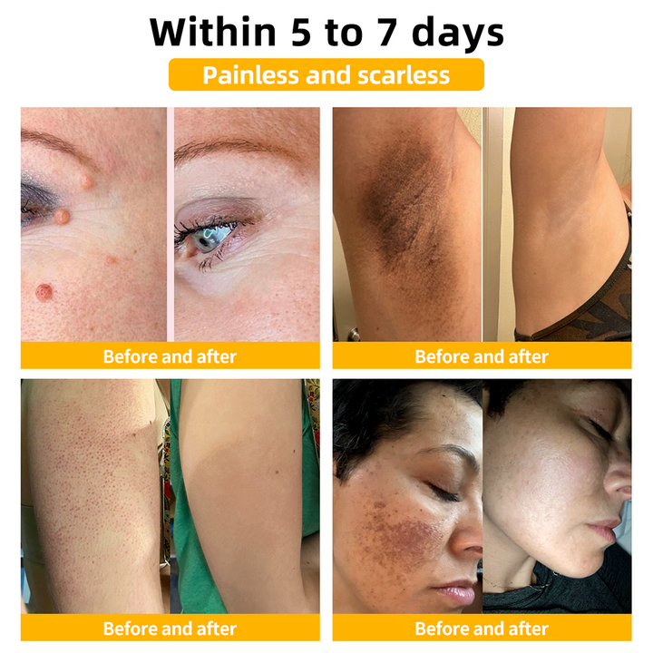 TagAway | Effective removal of warts and skin growths