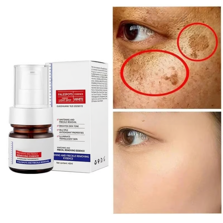 SpotLuxe | serum to remove dark spots